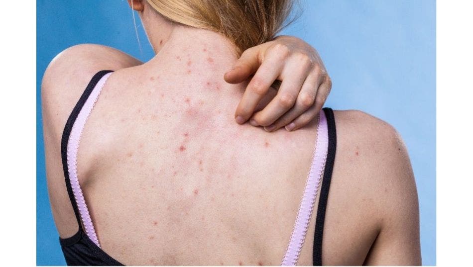 How to tackle acne on your body