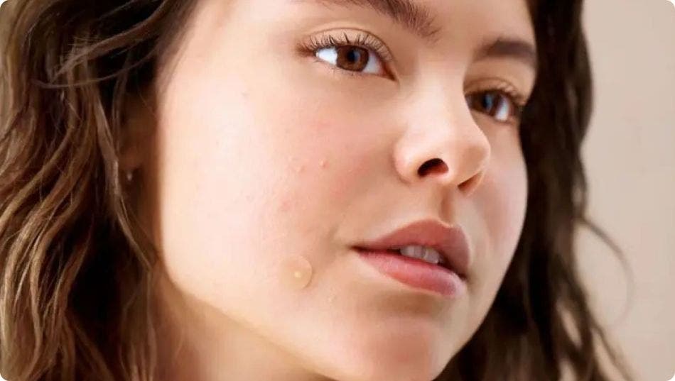 Pimple Patches 101: How do spot patches work?